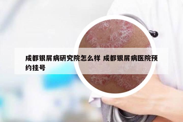 成都银屑病研究院怎么样 成都银屑病医院预约挂号
