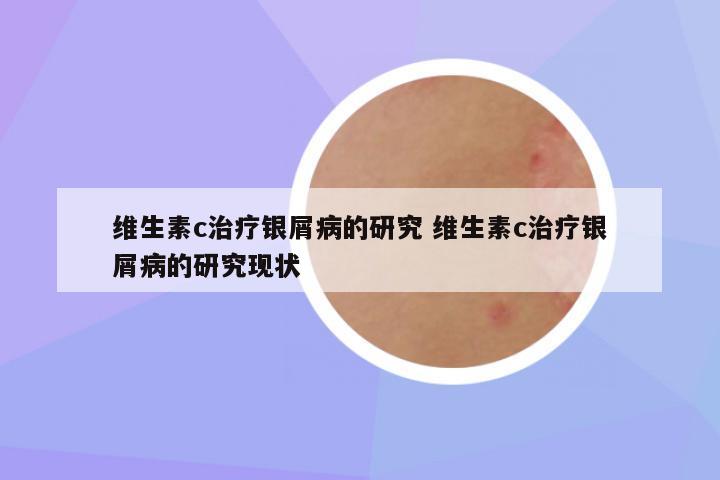 维生素c治疗银屑病的研究 维生素c治疗银屑病的研究现状