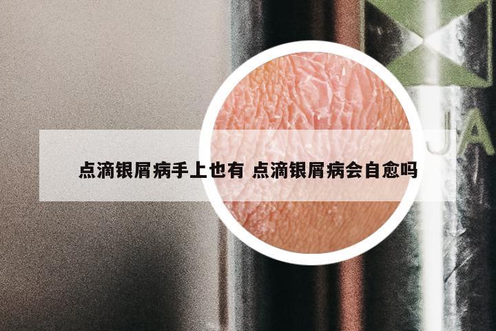 点滴银屑病手上也有 点滴银屑病会自愈吗