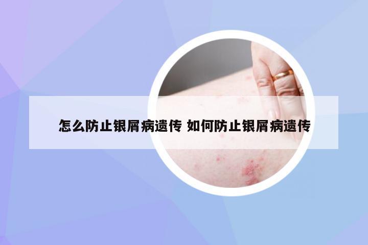 怎么防止银屑病遗传 如何防止银屑病遗传
