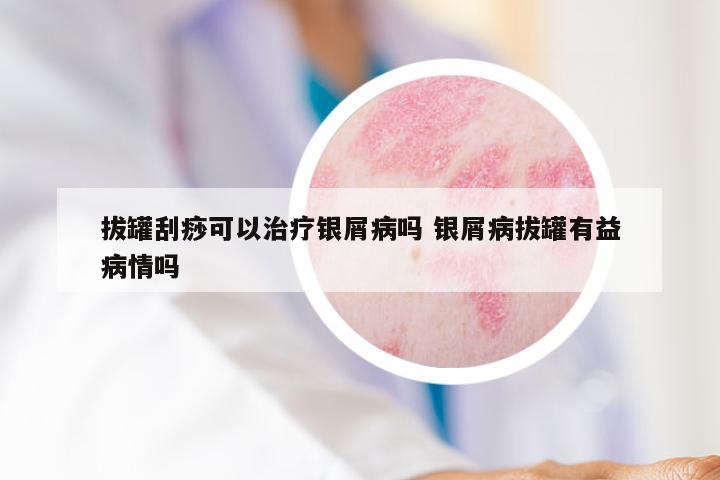 拔罐刮痧可以治疗银屑病吗 银屑病拔罐有益病情吗