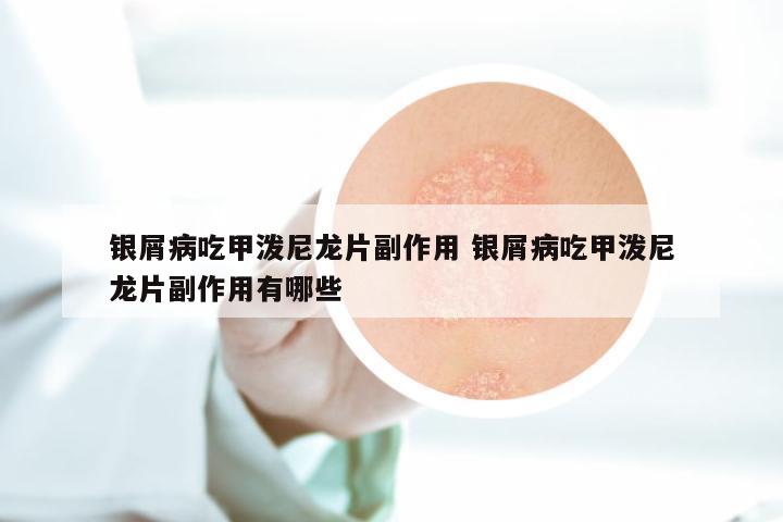 银屑病吃甲泼尼龙片副作用 银屑病吃甲泼尼龙片副作用有哪些