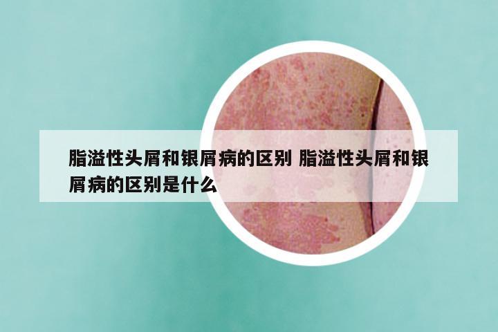 脂溢性头屑和银屑病的区别 脂溢性头屑和银屑病的区别是什么
