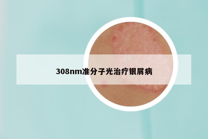 308nm准分子光治疗银屑病