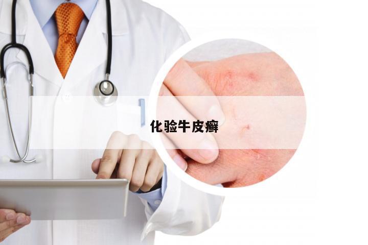 化验牛皮癣
