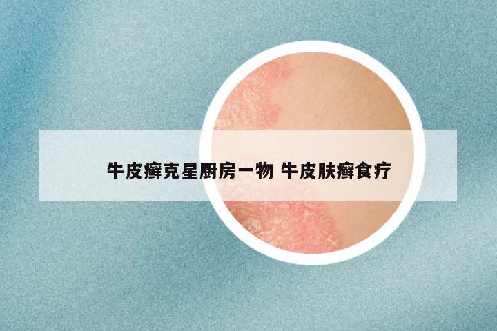 牛皮癣克星厨房一物 牛皮肤癣食疗