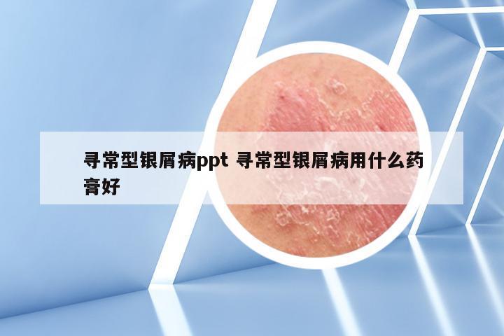 寻常型银屑病ppt 寻常型银屑病用什么药膏好