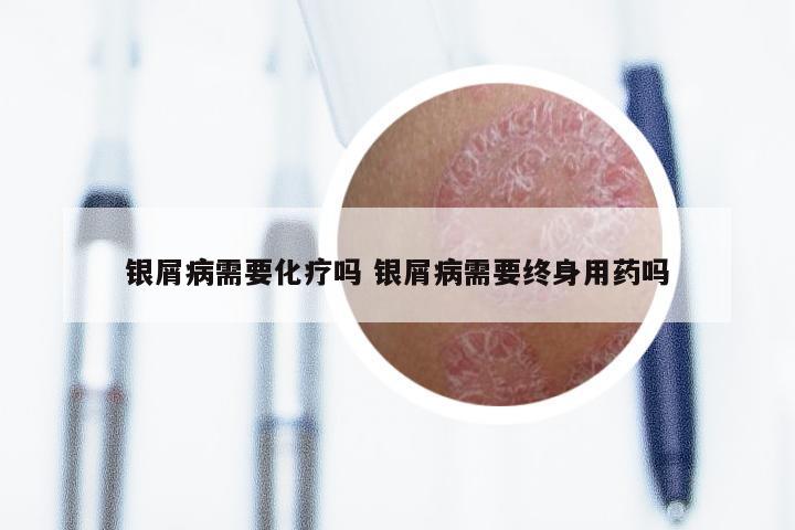 银屑病需要化疗吗 银屑病需要终身用药吗