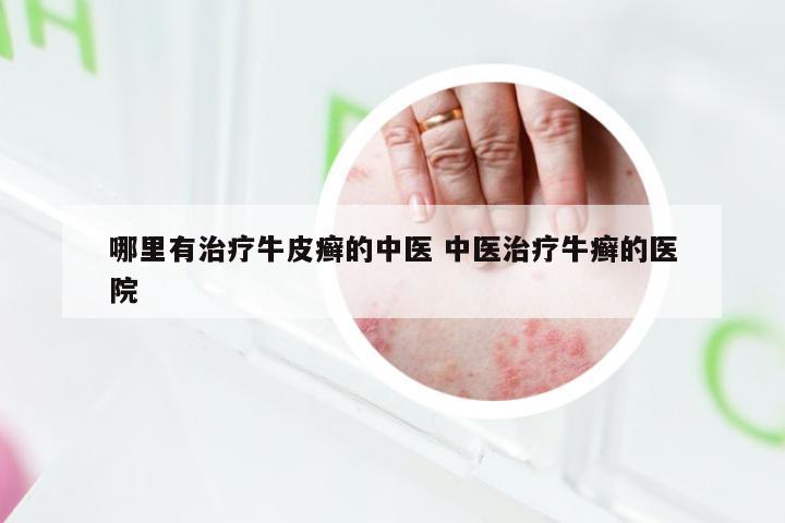 哪里有治疗牛皮癣的中医 中医治疗牛癣的医院