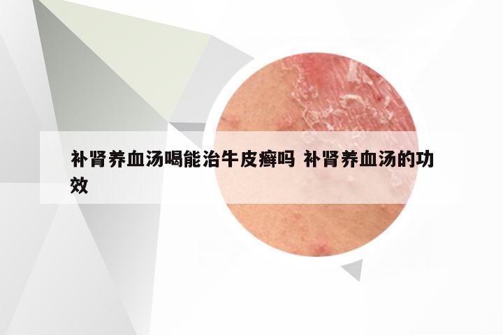 补肾养血汤喝能治牛皮癣吗 补肾养血汤的功效