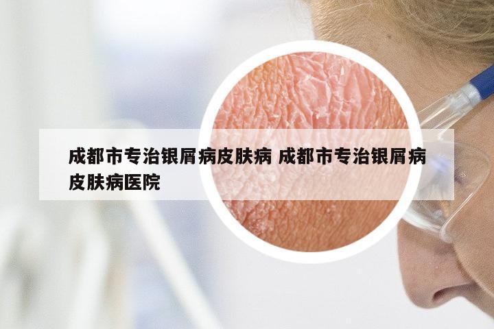 成都市专治银屑病皮肤病 成都市专治银屑病皮肤病医院