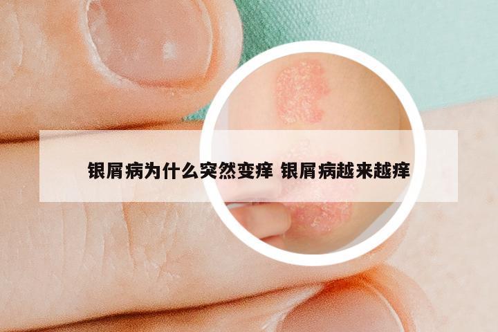 银屑病为什么突然变痒 银屑病越来越痒