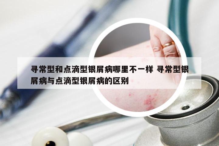 寻常型和点滴型银屑病哪里不一样 寻常型银屑病与点滴型银屑病的区别