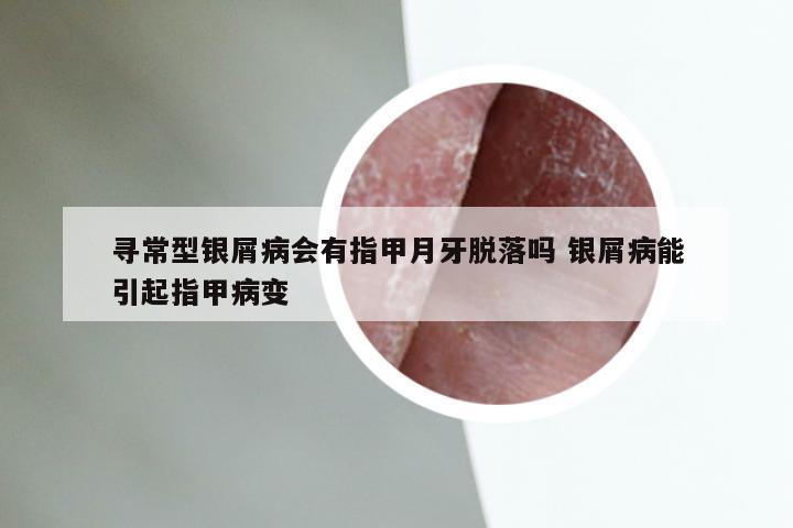 寻常型银屑病会有指甲月牙脱落吗 银屑病能引起指甲病变