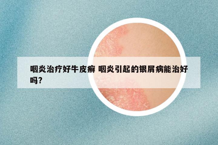 咽炎治疗好牛皮癣 咽炎引起的银屑病能治好吗?