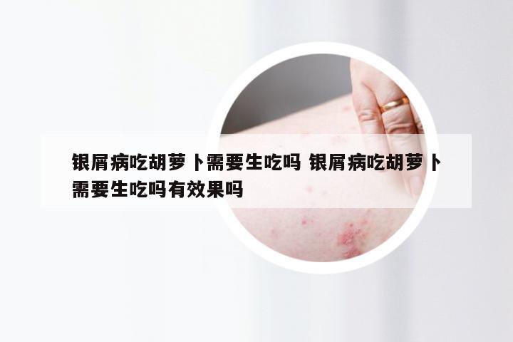 银屑病吃胡萝卜需要生吃吗 银屑病吃胡萝卜需要生吃吗有效果吗