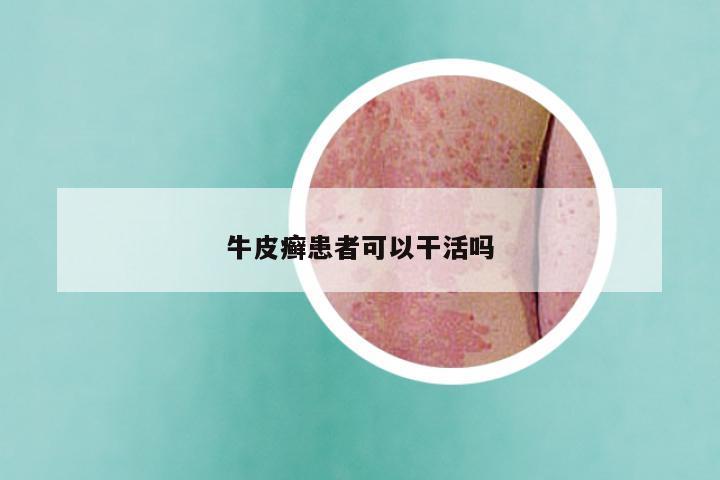 牛皮癣患者可以干活吗