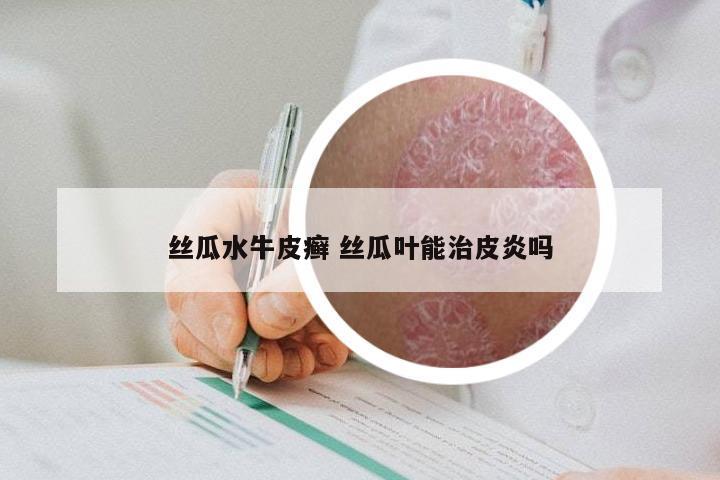 丝瓜水牛皮癣 丝瓜叶能治皮炎吗