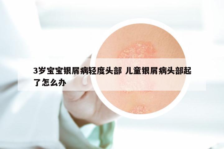 3岁宝宝银屑病轻度头部 儿童银屑病头部起了怎么办