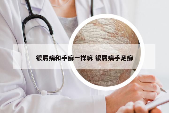 银屑病和手癣一样嘛 银屑病手足癣