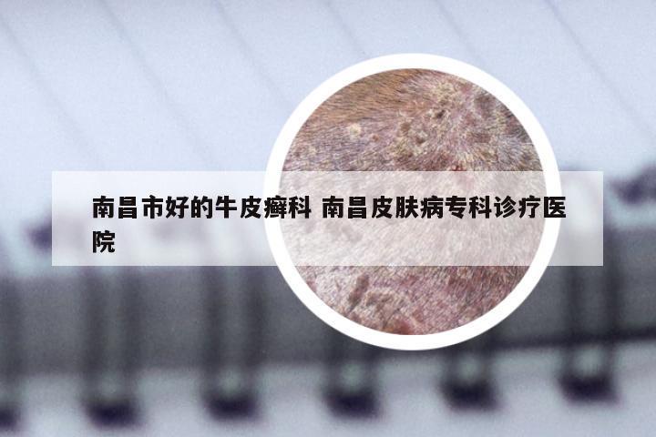 南昌市好的牛皮癣科 南昌皮肤病专科诊疗医院