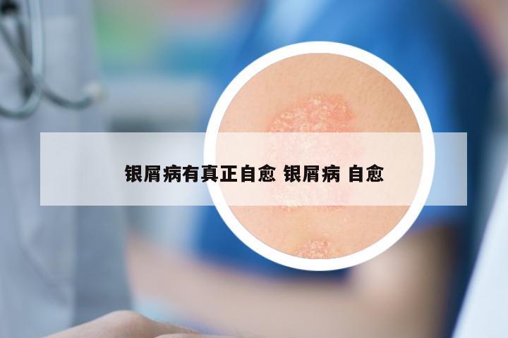 银屑病有真正自愈 银屑病 自愈