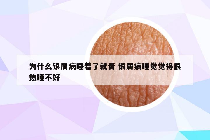 为什么银屑病睡着了就青 银屑病睡觉觉得很热睡不好