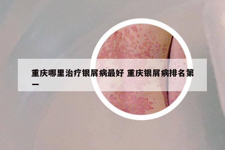 重庆哪里治疗银屑病最好 重庆银屑病排名第一