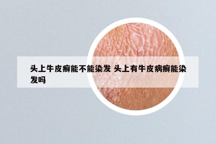 头上牛皮癣能不能染发 头上有牛皮病癣能染发吗