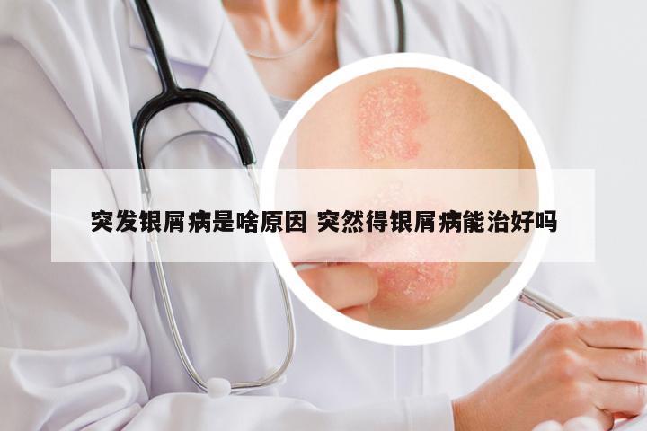 突发银屑病是啥原因 突然得银屑病能治好吗