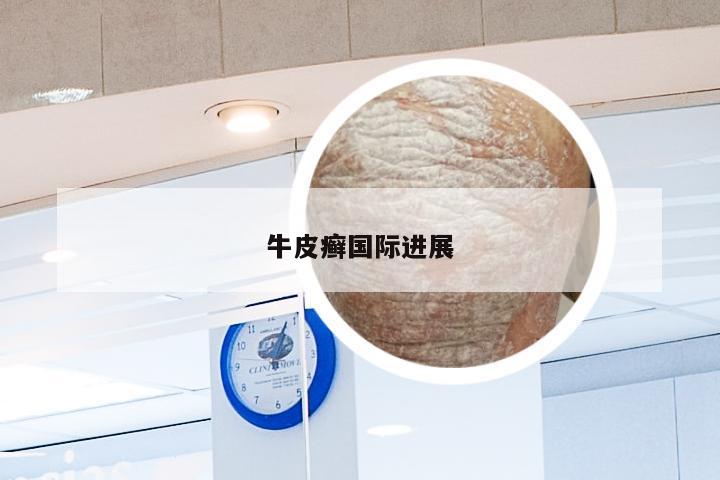 牛皮癣国际进展