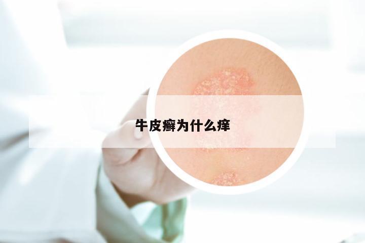 牛皮癣为什么痒