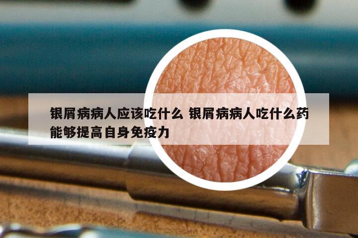 银屑病病人应该吃什么 银屑病病人吃什么药能够提高自身免疫力