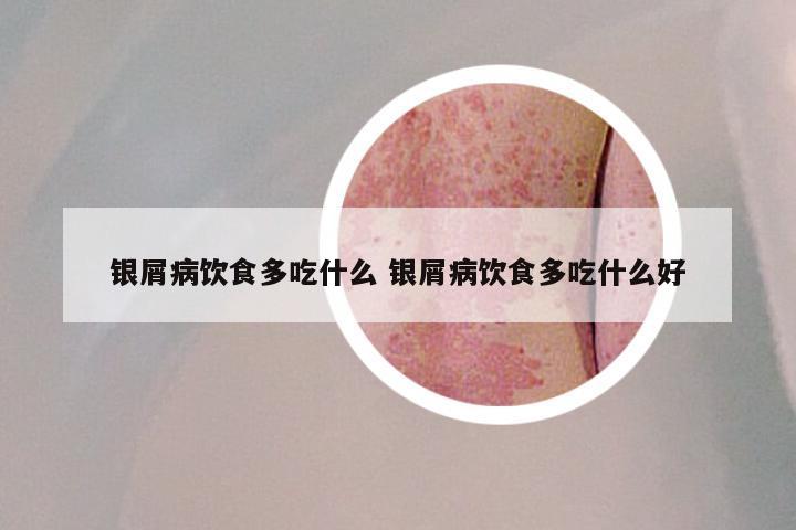 银屑病饮食多吃什么 银屑病饮食多吃什么好