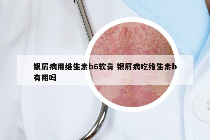 银屑病用维生素b6软膏 银屑病吃维生素b有用吗