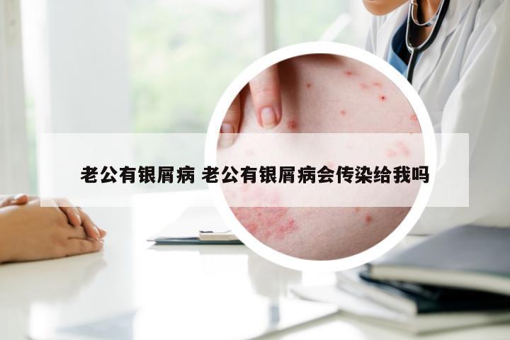 老公有银屑病 老公有银屑病会传染给我吗