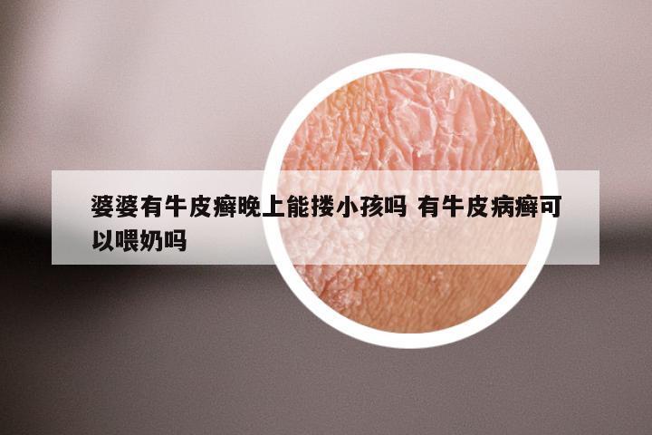 婆婆有牛皮癣晚上能搂小孩吗 有牛皮病癣可以喂奶吗