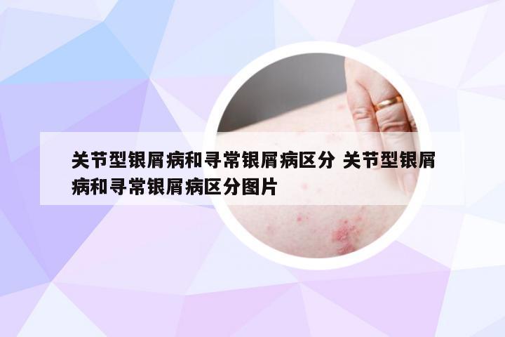 关节型银屑病和寻常银屑病区分 关节型银屑病和寻常银屑病区分图片