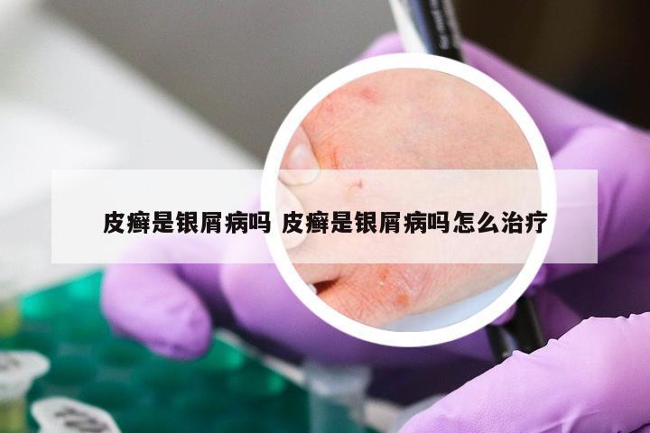皮癣是银屑病吗 皮癣是银屑病吗怎么治疗
