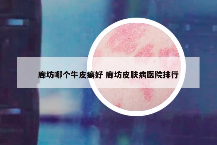 廊坊哪个牛皮癣好 廊坊皮肤病医院排行