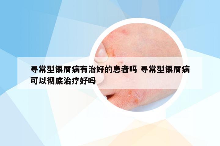 寻常型银屑病有治好的患者吗 寻常型银屑病可以彻底治疗好吗