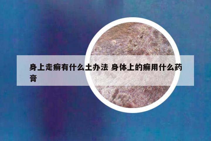 身上走癣有什么土办法 身体上的癣用什么药膏
