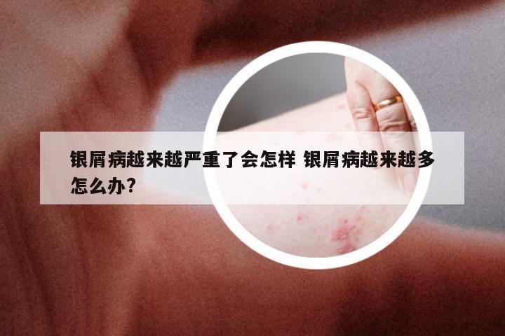 银屑病越来越严重了会怎样 银屑病越来越多怎么办?