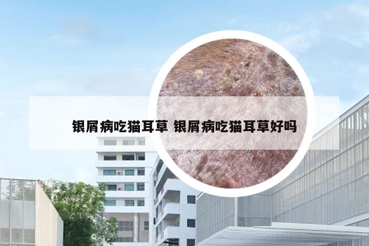 银屑病吃猫耳草 银屑病吃猫耳草好吗
