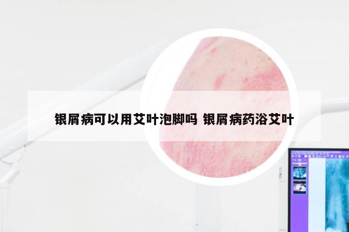 银屑病可以用艾叶泡脚吗 银屑病药浴艾叶
