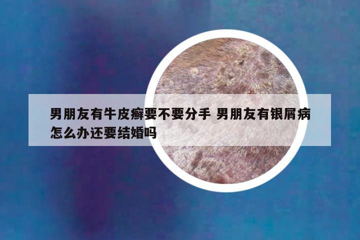 男朋友有牛皮癣要不要分手 男朋友有银屑病怎么办还要结婚吗