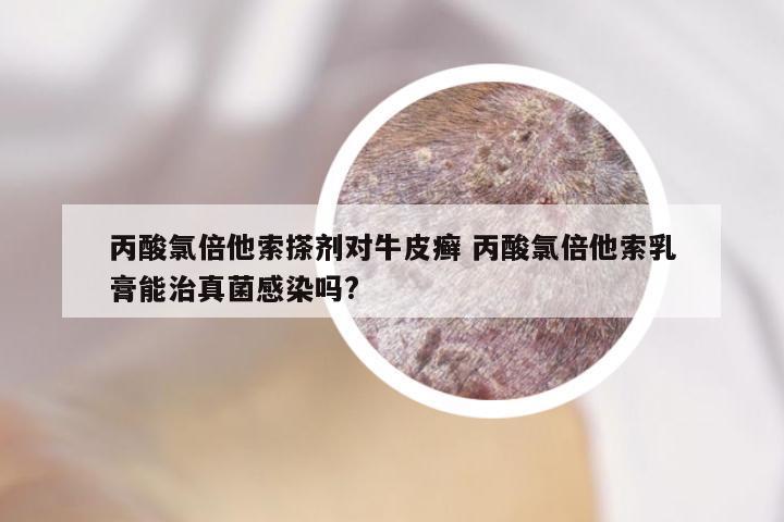 丙酸氯倍他索搽剂对牛皮癣 丙酸氯倍他索乳膏能治真菌感染吗?