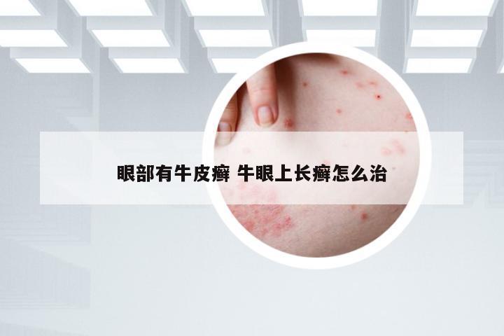 眼部有牛皮癣 牛眼上长癣怎么治