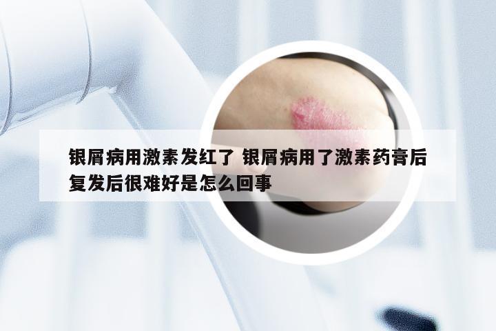 银屑病用激素发红了 银屑病用了激素药膏后复发后很难好是怎么回事