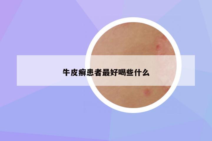 牛皮癣患者最好喝些什么